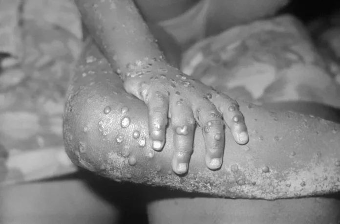 Monkeypox: The myths, misconceptions — and facts — about how you catch it
